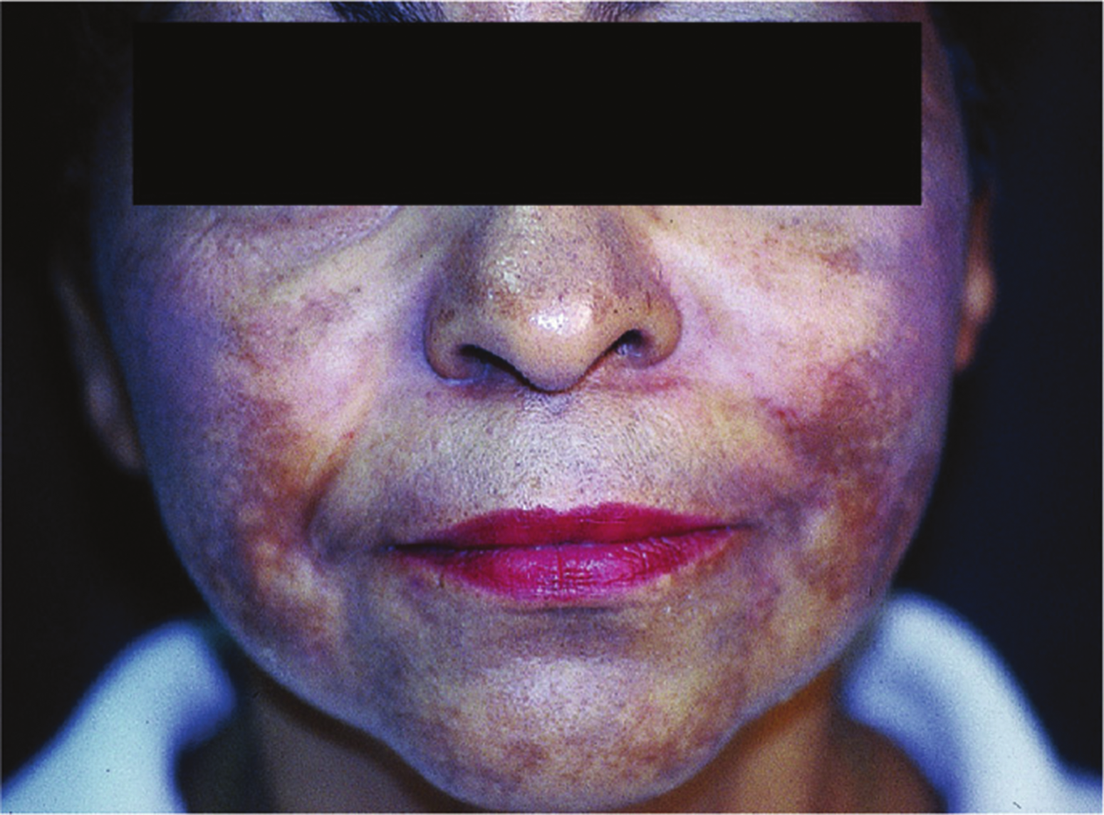 Diffuse Melasma