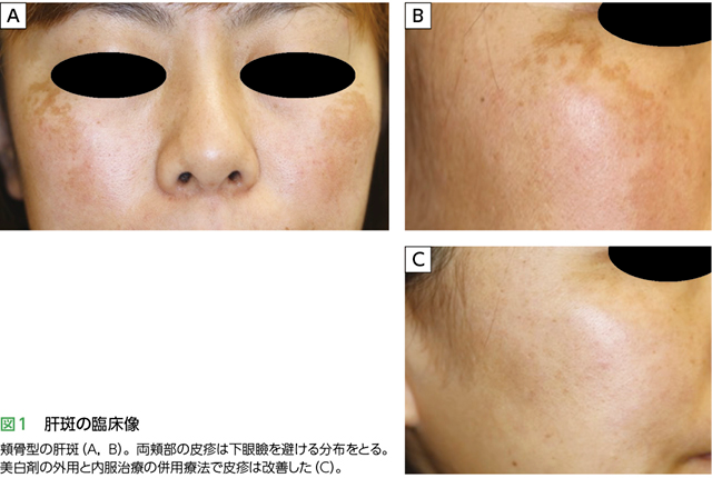 肝斑臨床像