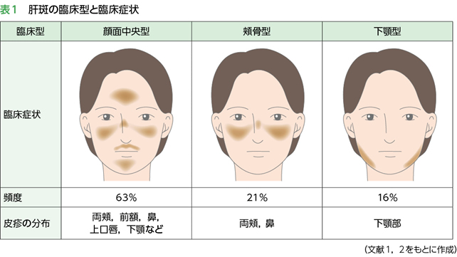 肝斑の臨床型分類