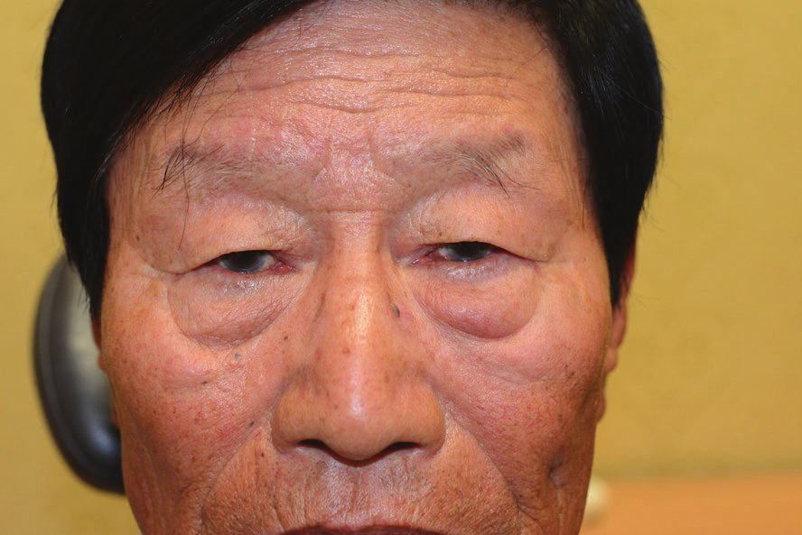 下眼瞼加齢変化
