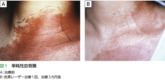 苺状血管腫治療