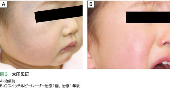 蒙古斑治療