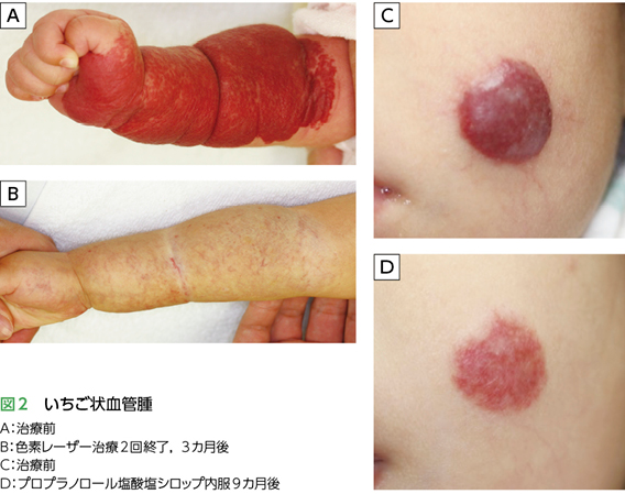 太田母斑治療