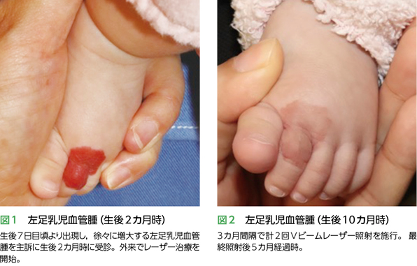 苺状血管腫症例