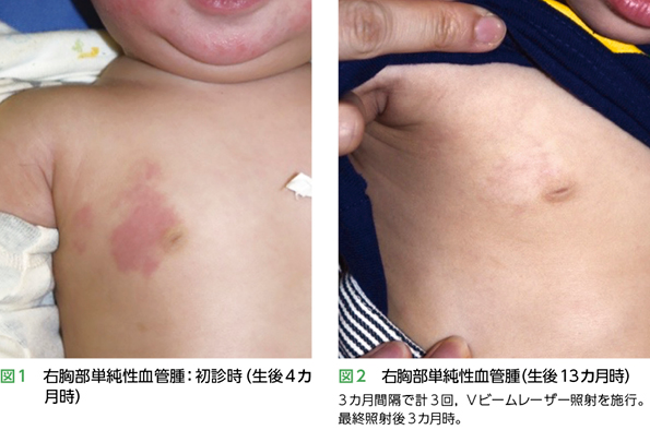 単純性血管腫症例