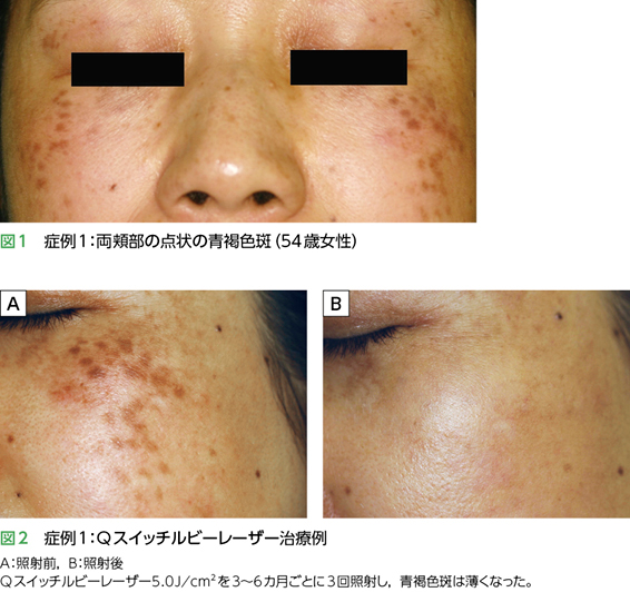 症例1 治療前