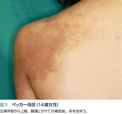 症例2 治療後