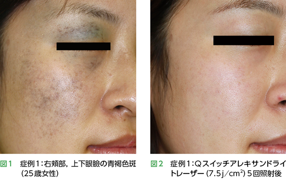 太田母斑症例1