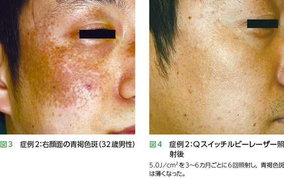 太田母斑症例2