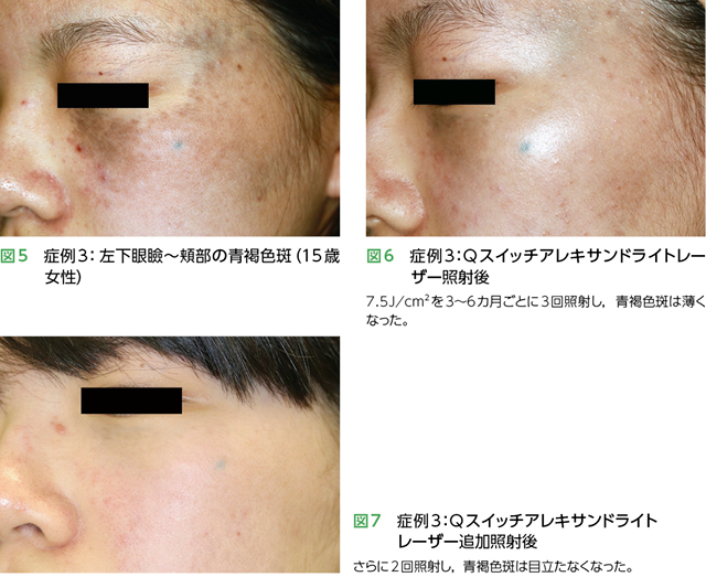 太田母斑症例3