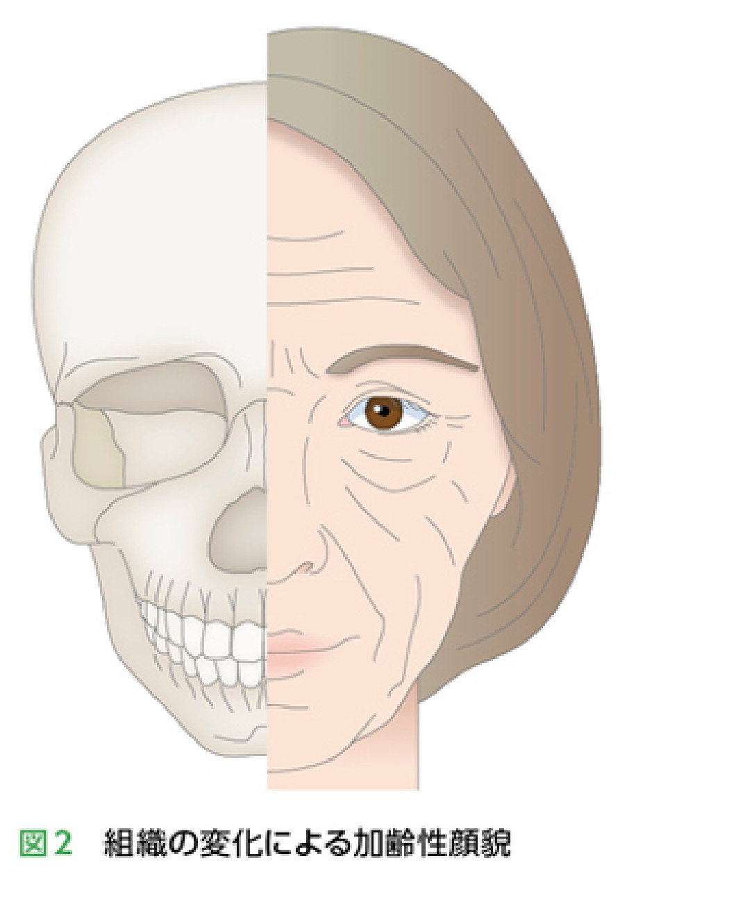 骨吸収・軟部組織萎縮による加齢性顔貌