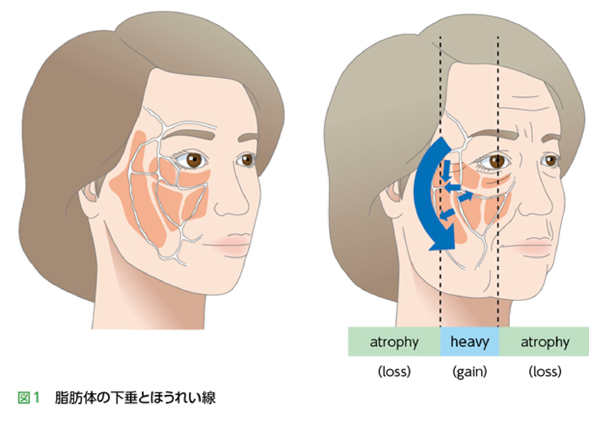 脂肪体の下垂とほうれい線形成