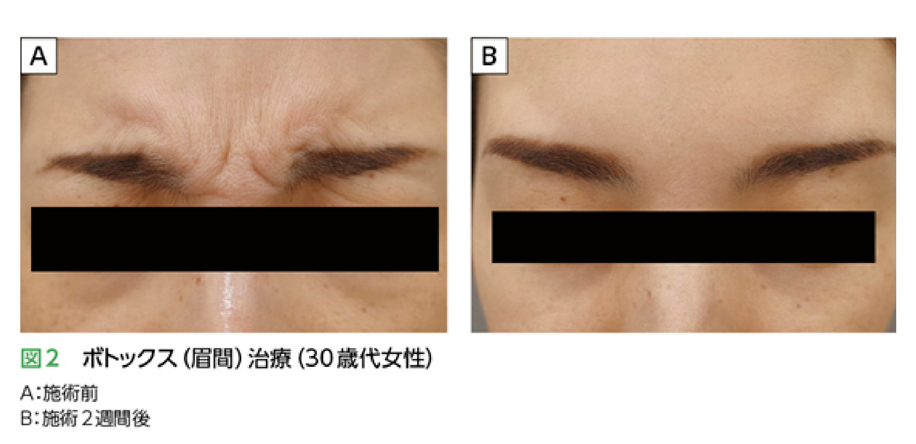 ボトックス（眉間）治療の施術前後