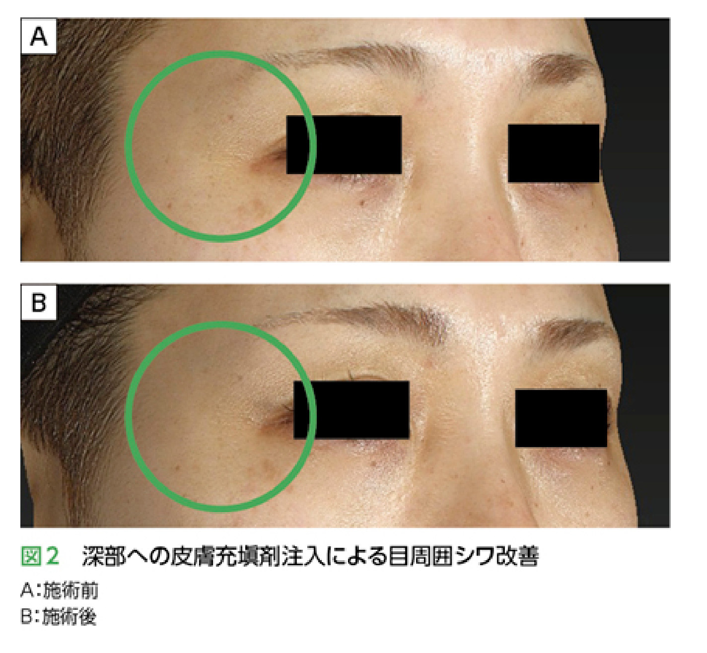 深部への皮膚充填剤注入による目周囲シワ改善（施術前後）