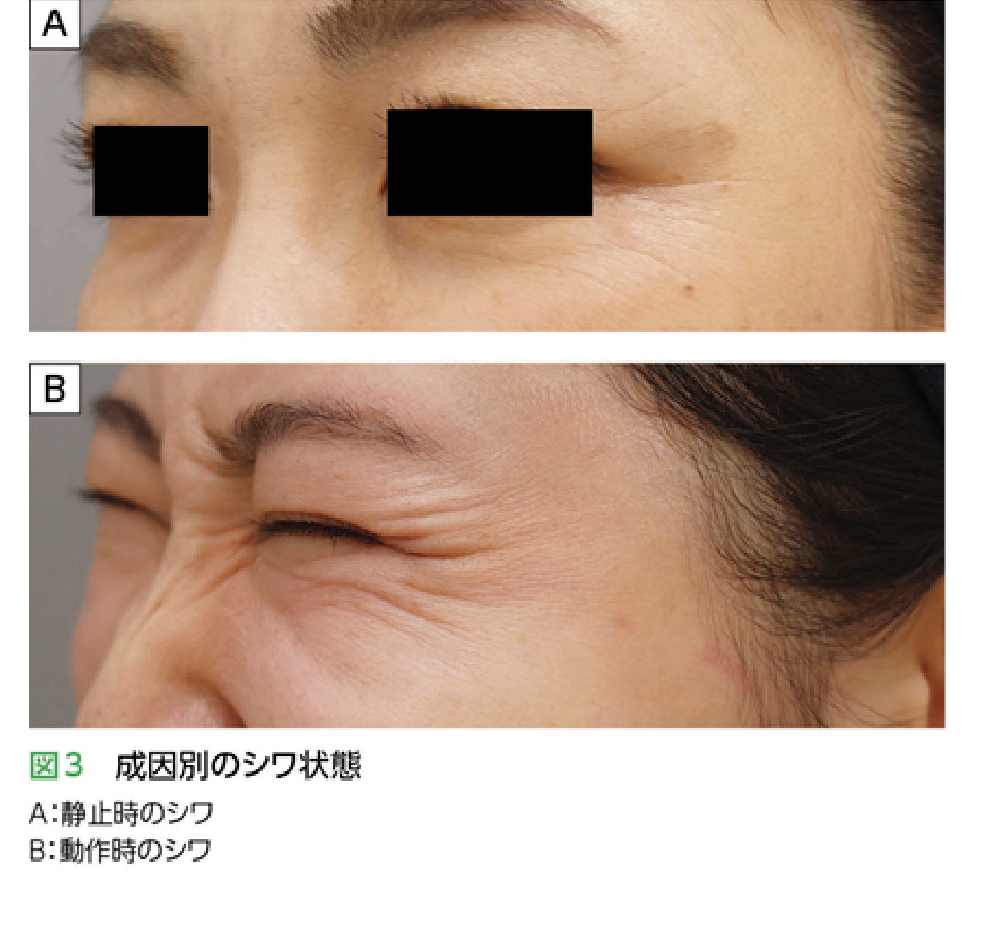 成因別の目尻シワ（静止時と動作時）