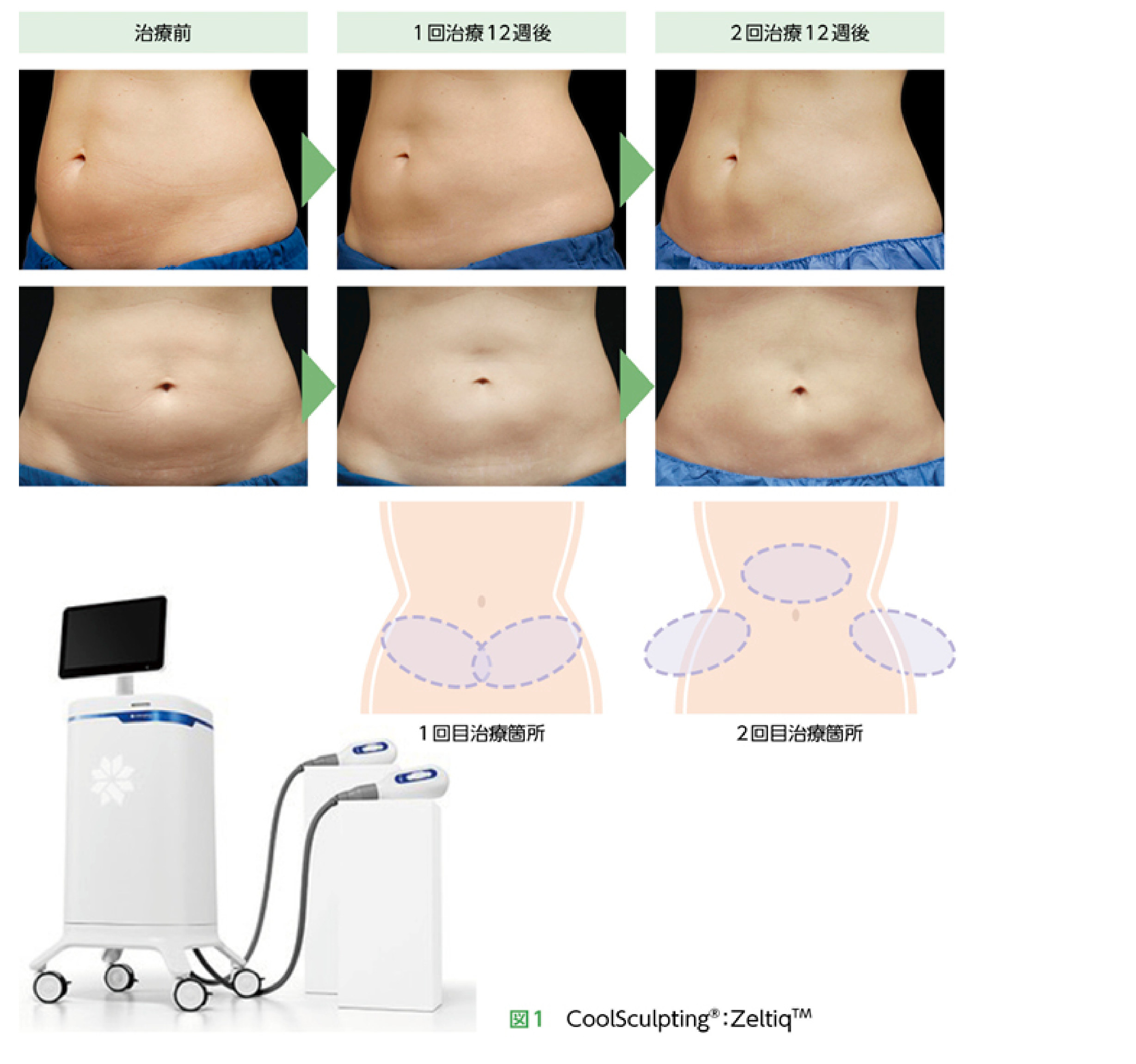 冷却脂肪溶解（CoolSculpting）による腹部の施術前後